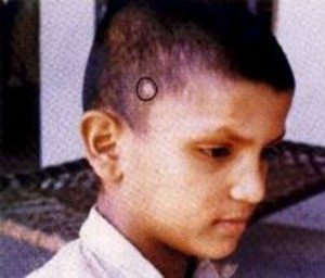 5 Past Life Scar or Reincarnation Birthmark-Titu Singh